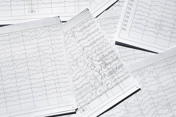 Cryolipolyse le mans : votre diagnostic offert!